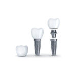 Dantal Implants