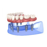 Dantal Implants